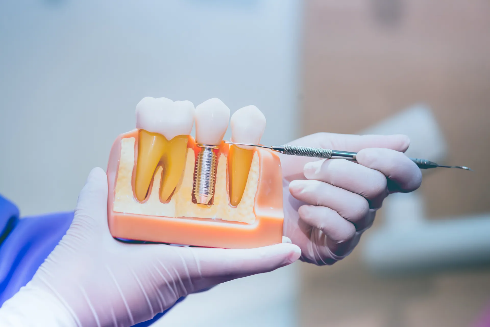Dental implant treatment and restoration at Cedar Rapids Smile Center