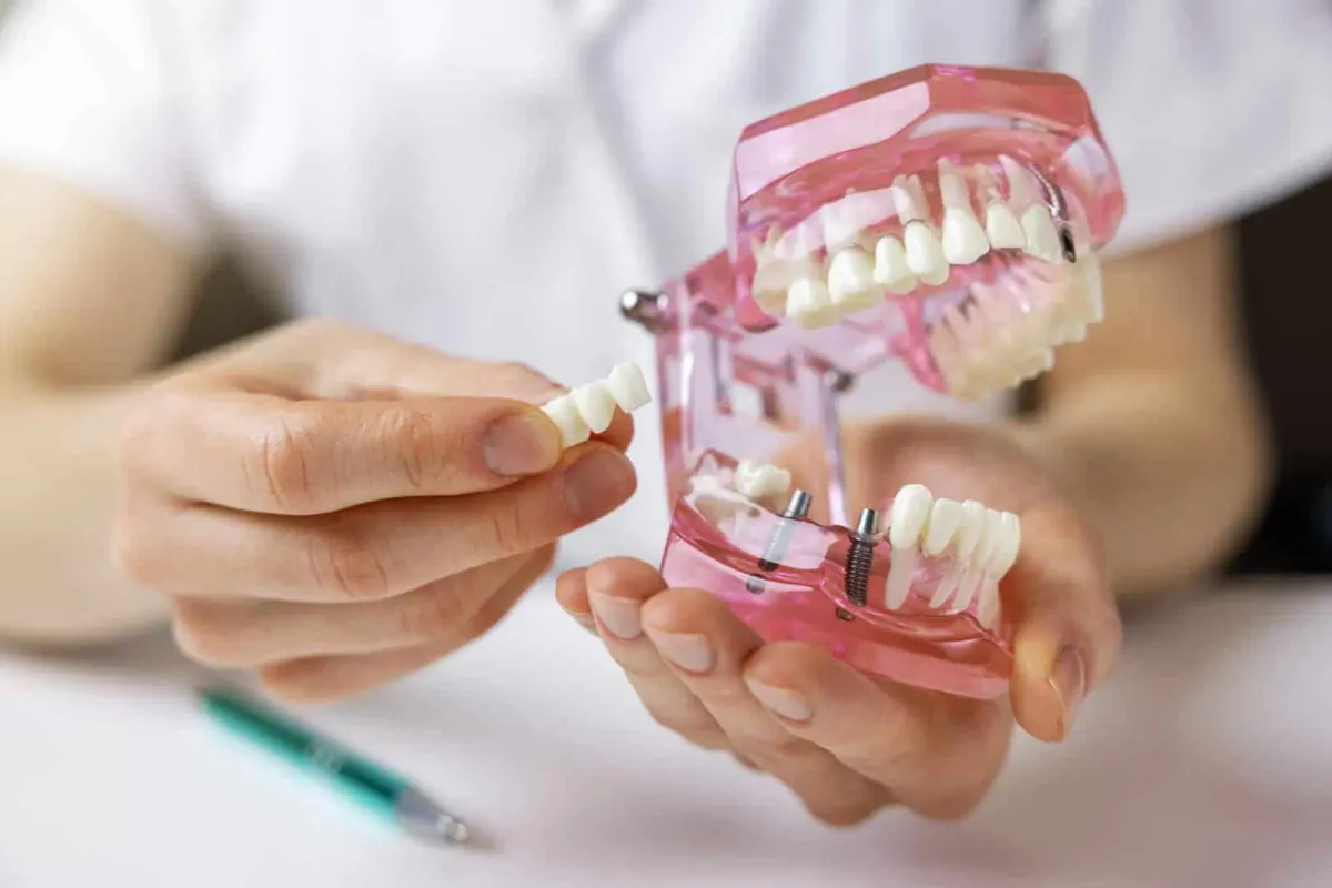 Crowns & Bridges at Cedar Rapids Smile Center in Cedar Rapids, IA