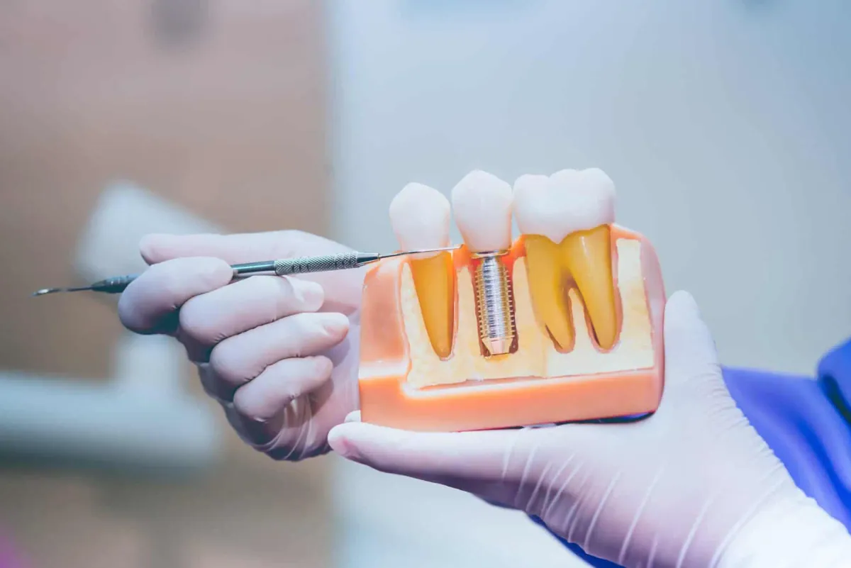 Dental Implants at Cedar Rapids Smile Center in Cedar Rapids, IA
