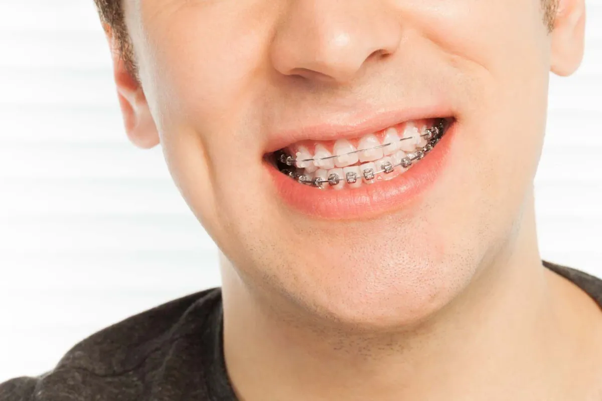 Fastbraces at Cedar Rapids Smile Center in Cedar Rapids, IA