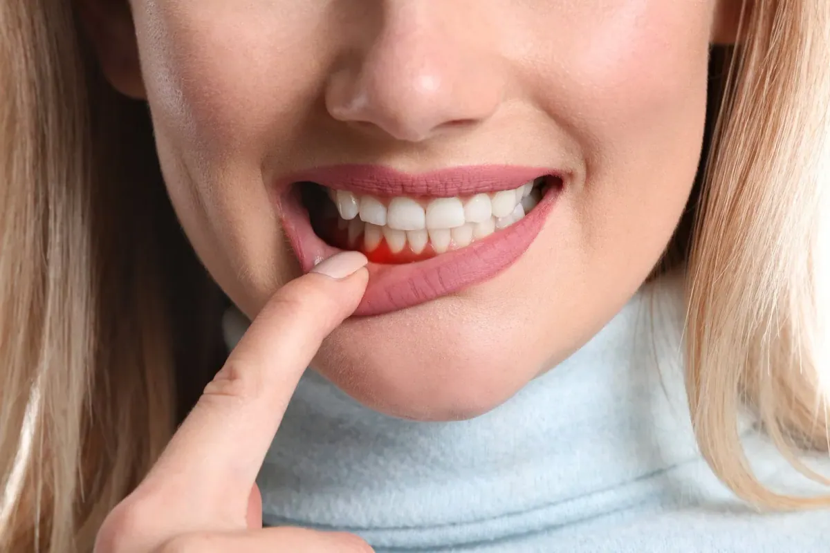 Gingivitis Treatment at Cedar Rapids Smile Center in Cedar Rapids, IA