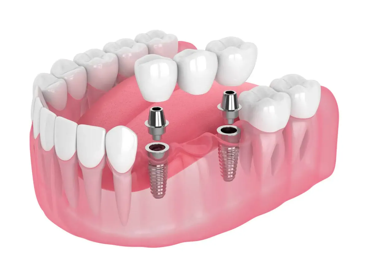 Implant-Supported Dentures at Cedar Rapids Smile Center in Cedar Rapids, IA