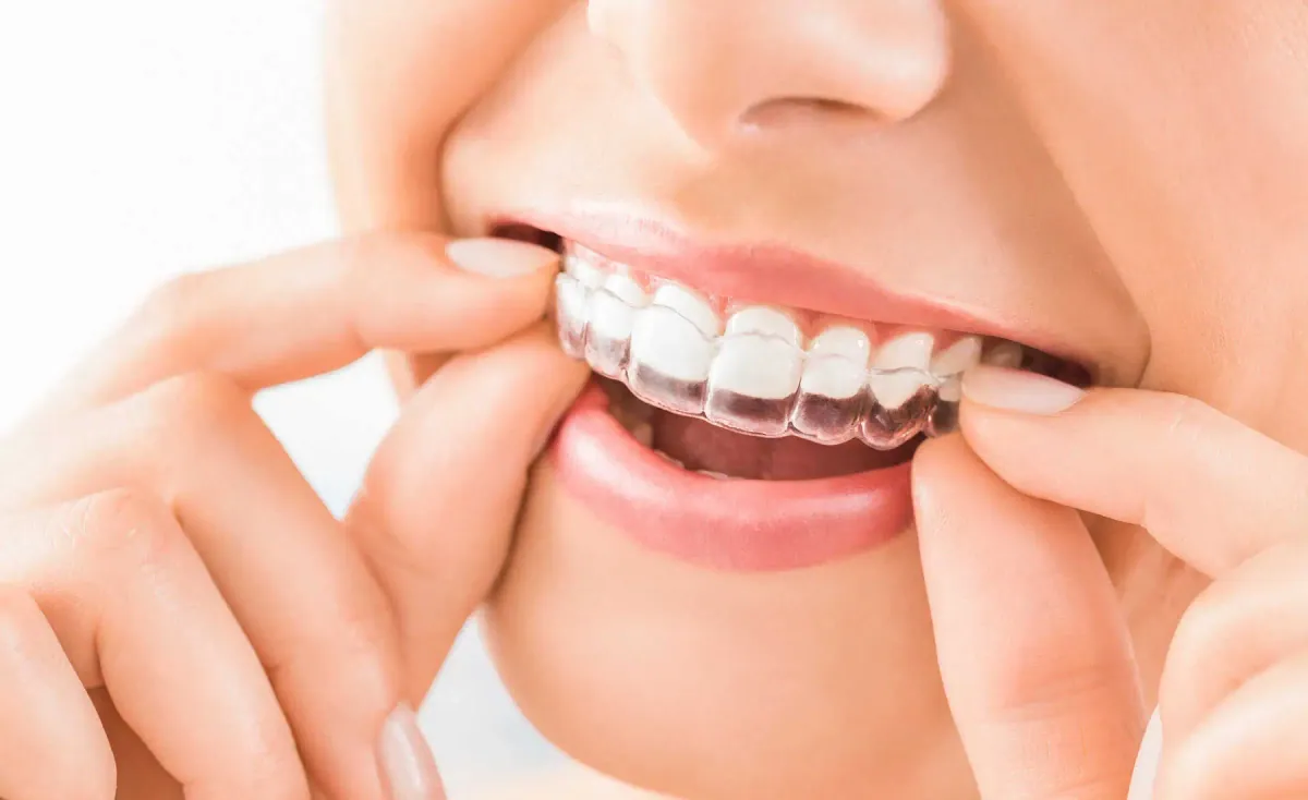 Invisalign at Cedar Rapids Smile Center in Cedar Rapids, IA