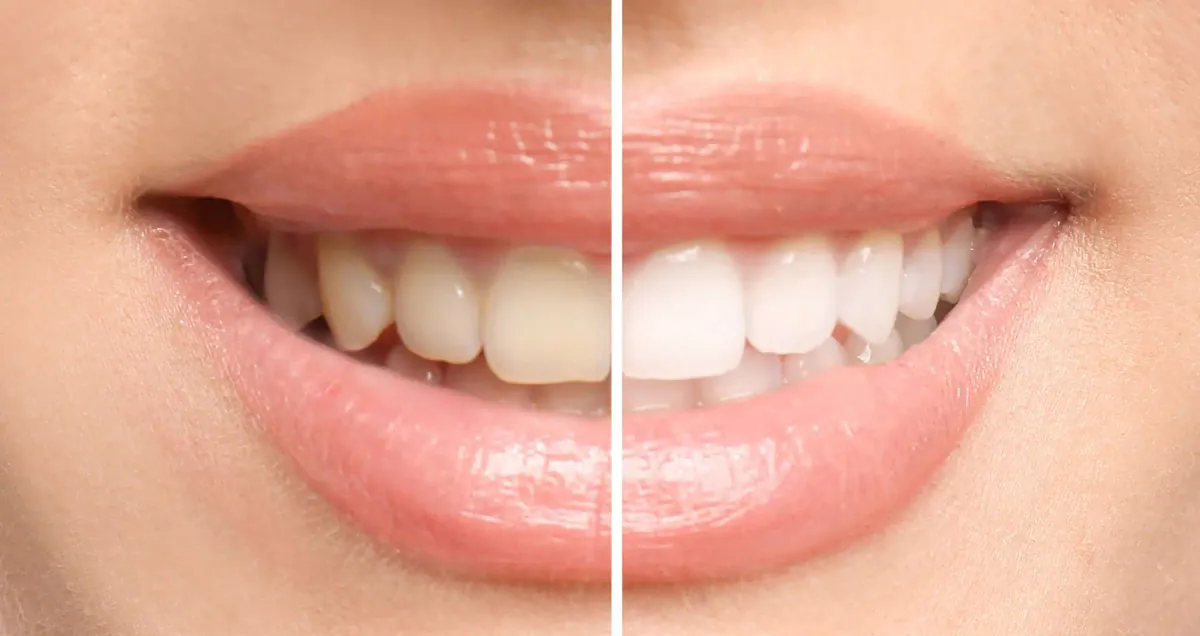 Teeth Whitening at Cedar Rapids Smile Center in Cedar Rapids, IA